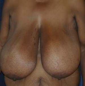 Breast Reduction Before
