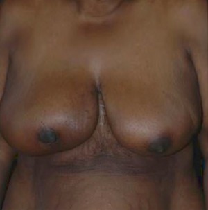 Breast Reduction after