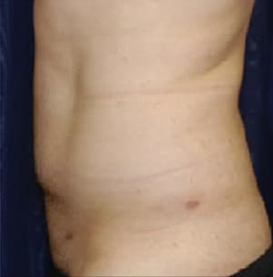 Liposuction Before & After Results