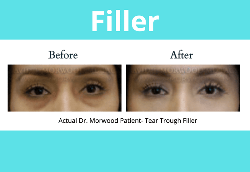 Fillers Before and After Photos