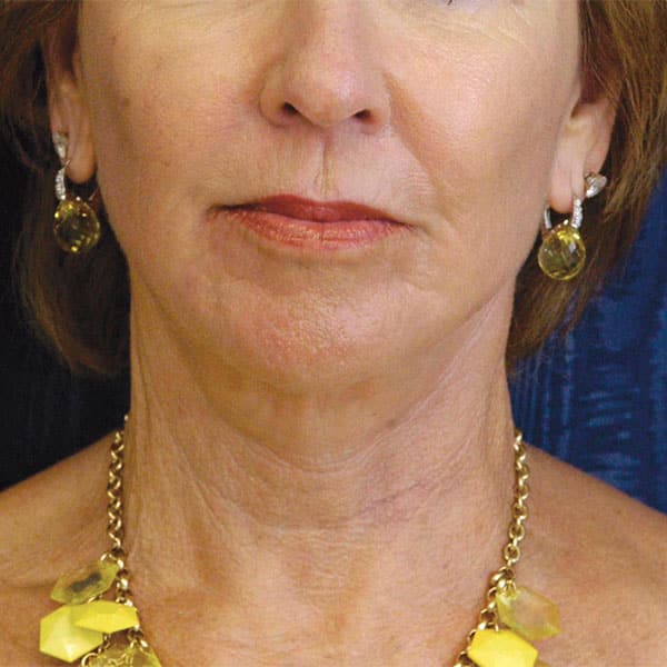 Volumetric Restoration After Photos