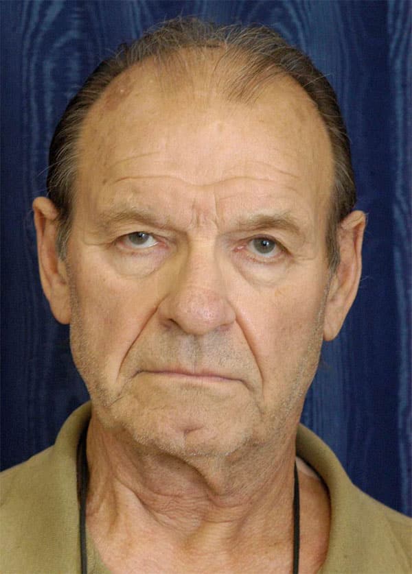 Natural Neck Lift for Men Before Photos