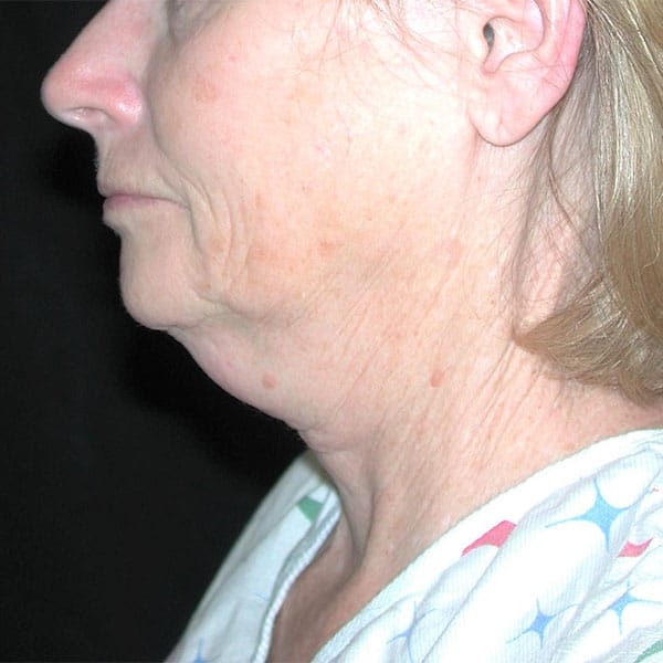 Loose muscle on chin before necklift procedure