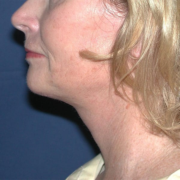 Loose muscle on chin after necklift procedure