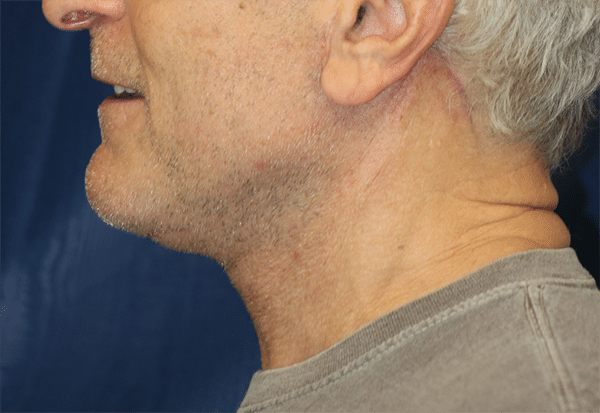 Natural Necklift Before Photos