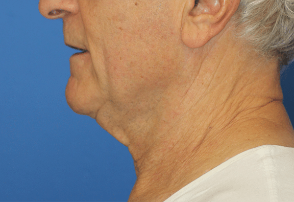 Natural Necklift Before Photos