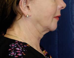 Natural Neck Lift Before and After Photos Natural Neck Lift Before and After Photos