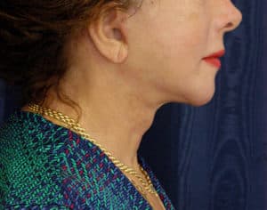 Natural Neck Lift Before and After Photos Natural Neck Lift Before and After Photos